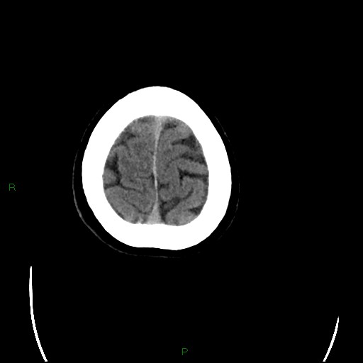 Cerebral amyloid angiopathy (Radiopaedia 77506-89665 Axial non-contrast 101).jpg