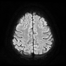 File:Cerebral and spinal tuberculosis (Radiopaedia 90489-107837 Axial DWI 17).jpg