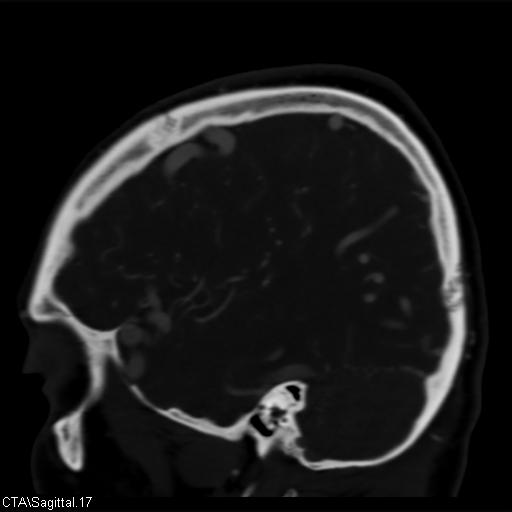 Cerebral arteriovenous malformation (Radiopaedia 28518-28759 D 14).jpg