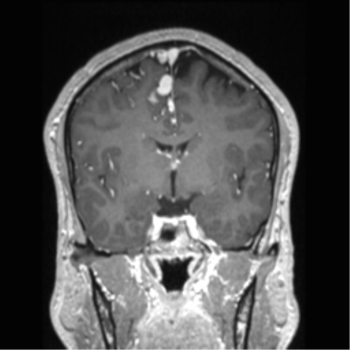 Cerebral arteriovenous malformation (Radiopaedia 39259-41506 Coronal T1 C+ 54).png