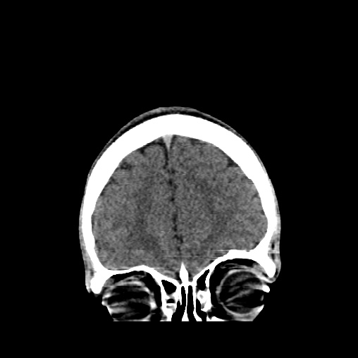 File:Cerebral arteriovenous malformation (Radiopaedia 61964-70028 Coronal non-contrast 11).jpg