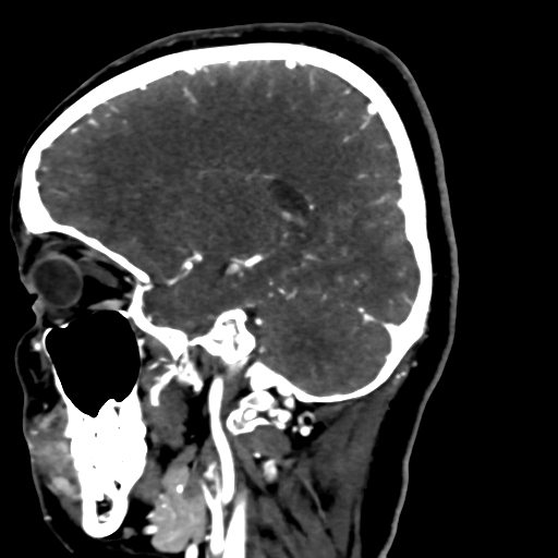 Cerebral arteriovenous malformation (Radiopaedia 73830-84645 Sagittal C+ delayed 32).jpg