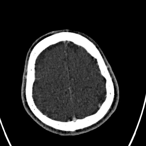 Cerebral arteriovenous malformation (Radiopaedia 78188-90746 Axial C+ delayed 143).jpg
