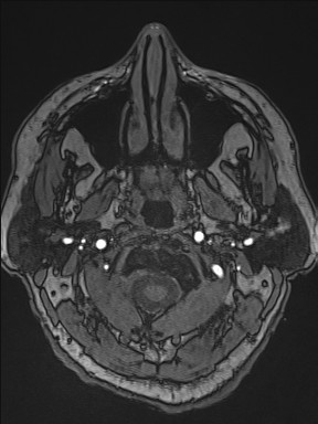 Cerebral arteriovenous malformation (Radiopaedia 84015-99245 Axial TOF 17).jpg