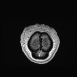 Cerebral arteriovenous malformation (Radiopaedia 84015-99245 Coronal T1 C+ 169).jpg