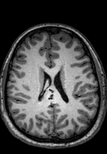 File:Cerebral arteriovenous malformation at posterior body of corpus callosum (Radiopaedia 74111-84925 Axial T1 107).jpg