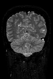 Cerebral arteriovenous malformation at posterior body of corpus callosum (Radiopaedia 74111-84925 Coronal T2 139).jpg