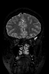 Cerebral arteriovenous malformation at posterior body of corpus callosum (Radiopaedia 74111-84925 Coronal T2 41).jpg