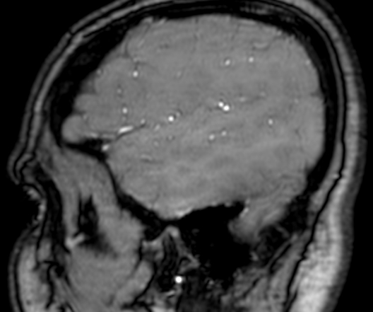 Cerebral arteriovenous malformation at posterior body of corpus callosum (Radiopaedia 74111-84925 J 353).jpg