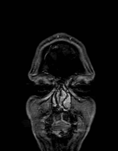 Cerebral arteriovenous malformation at posterior body of corpus callosum (Radiopaedia 74111-84925 K 2).jpg