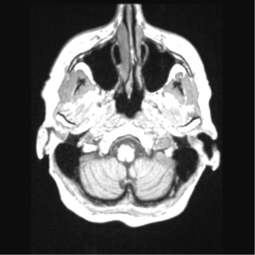 Cerebral arteriovenous malformation with hemorrhage (Radiopaedia 34422-35737 Axial T1 11).png