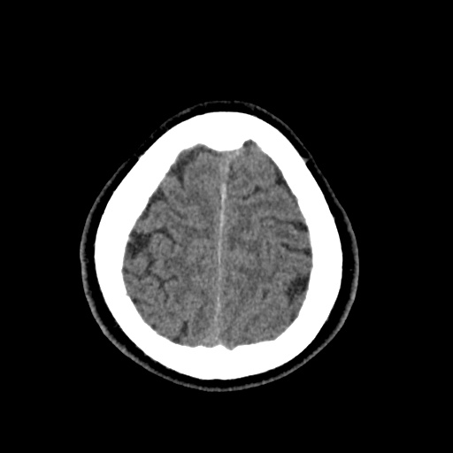 Cerebral arteriovenous malformation with lobar hemorrhage (Radiopaedia 35598-37117 Axial non-contrast 49).jpg