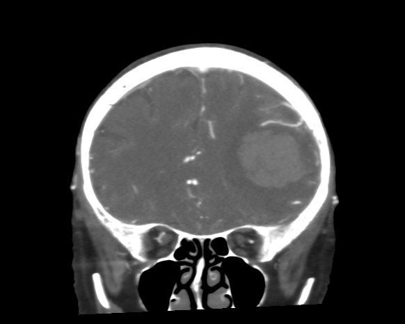 Cerebral arteriovenous malformation with lobar hemorrhage (Radiopaedia 44725-48511 A 18).png
