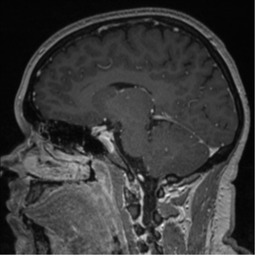 Cerebral cavernoma and development venous anomaly (Radiopaedia 37603-39482 Sagittal T1 C+ 54).png