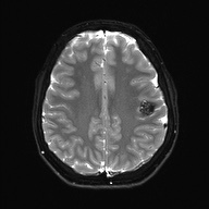 File:Cerebral cavernous venous malformation (Radiopaedia 70008-80021 Axial DWI 22).jpg