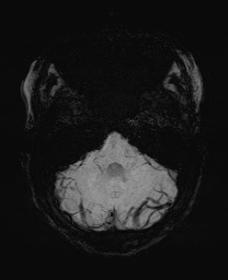 Cerebral cavernous venous malformation (Radiopaedia 70008-80021 Axial SWI 14).jpg