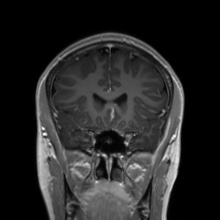 File:Cerebral cavernous venous malformation (Radiopaedia 70008-80021 Coronal T1 C+ 42).jpg