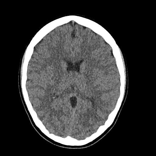 Cerebral cavernous venous malformation (Radiopaedia 70008-80022 Axial non-contrast 28).jpg