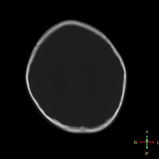 File:Cerebral contusion (Radiopaedia 48869-53911 Axial bone window 7).jpg