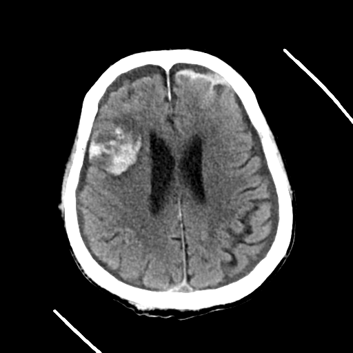 File:Cerebral contusions, subarachnoid hemorrhage and subdural hygromas (Radiopaedia 55399-61829 Axial non-contrast 13).png