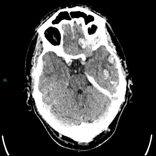 File:Cerebral contusions (Radiopaedia 33868-35039 Axial non-contrast 66).jpg