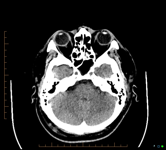 Cerebral fat embolism (Radiopaedia 85521-101220 Axial non-contrast 20).jpg