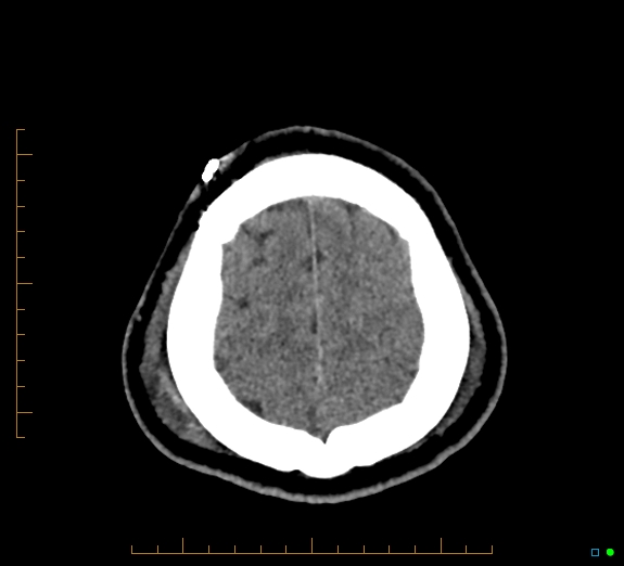 Cerebral fat embolism (Radiopaedia 85521-101224 Axial non-contrast 45).jpg