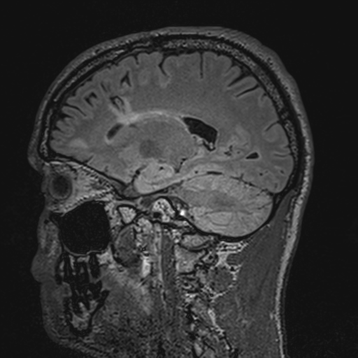File:Cerebral hemorrhagic contusions- temporal evolution (Radiopaedia 40224-42757 Sagittal T1 31).png