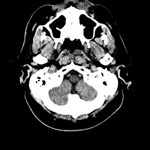 File:Cerebral hemorrhagic contusions and cervical spine fractures (Radiopaedia 32865-33841 Axial non-contrast 4).jpg