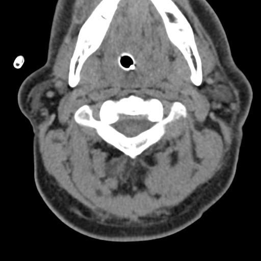 Cerebral hemorrhagic contusions and cervical spine fractures (Radiopaedia 32865-33841 F 15).jpg