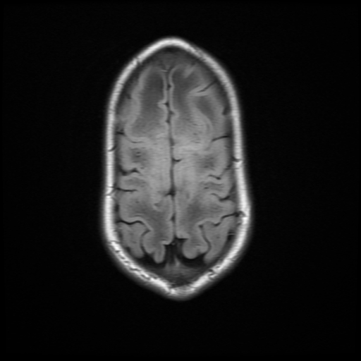 File:Cerebral manifestations of mucopolysaccharidosis type I (Radiopaedia 59171-66487 C 18).jpg