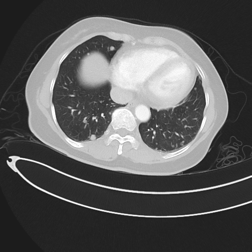 Cerebral metastases (Radiopaedia 33041-34055 Axial lung window 40).png