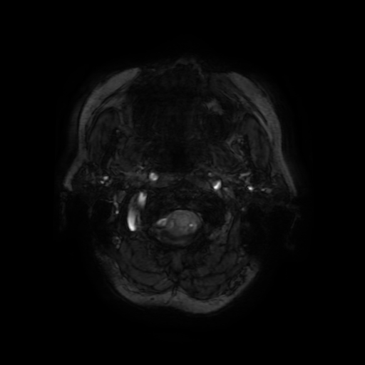 Cerebral metastases - melanoma (Radiopaedia 80972-94522 Axial SWI 3).jpg