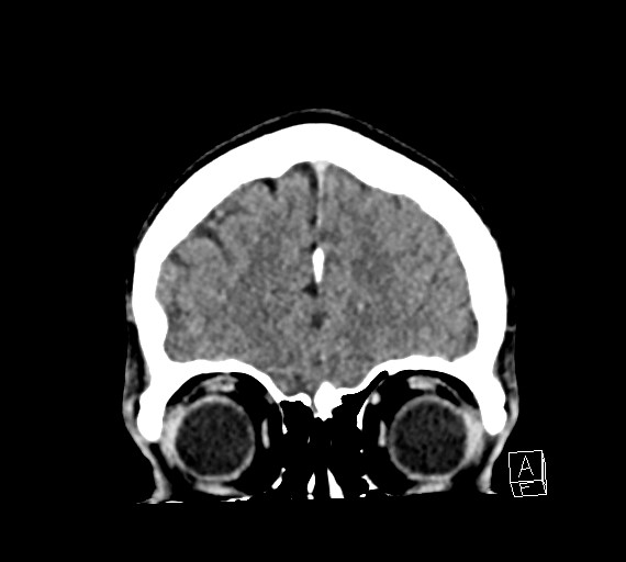 Cerebral metastases - testicular choriocarcinoma (Radiopaedia 84486-99855 D 12).jpg