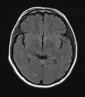 File:Cerebral metastases mimicking abscesses (Radiopaedia 45841-50131 Axial FLAIR 14).png