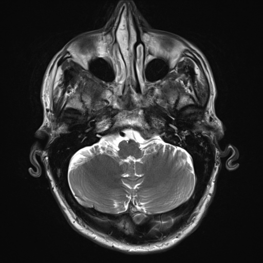 File:Cerebral metastasis - melanoma (Radiopaedia 54718-60954 Axial T2 7).png