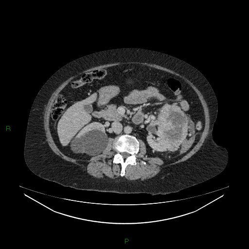 File:Cerebral metastasis from renal cell carcinoma (Radiopaedia 82306-96378 A 78).jpg