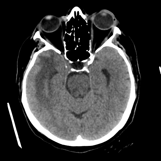 Cerebral metastasis to basal ganglia (Radiopaedia 81568-95412 Axial non-contrast 25).png