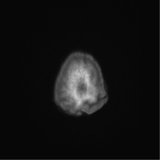 Cerebral metastasis to basal ganglia (Radiopaedia 81568-95413 Axial T1 75).png
