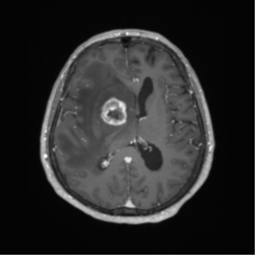 Cerebral metastasis to basal ganglia (Radiopaedia 81568-95413 Axial T1 C+ 41).png