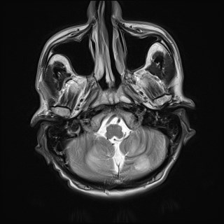 File:Cerebral toxoplasmosis (Radiopaedia 43956-47461 Axial T2 3).jpg