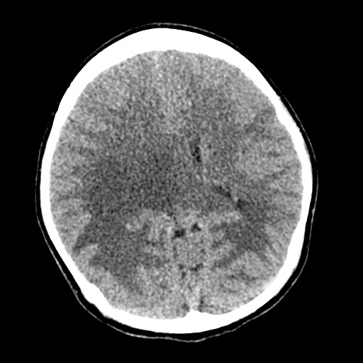 Cerebral tuberculosis with dural sinus invasion (Radiopaedia 60353-68018 Axial non-contrast 33).jpg