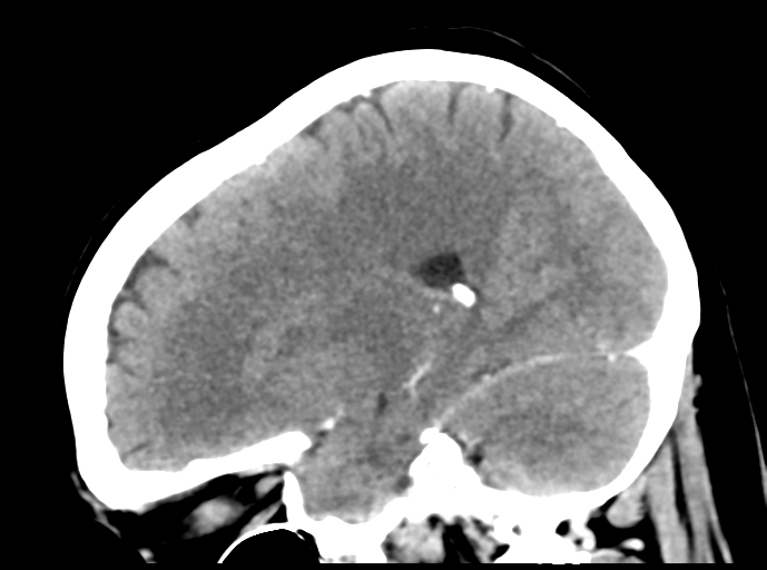 Cerebral venous hemorrhagic infarction (Radiopaedia 57576-64538 Sagittal C+ 34).png