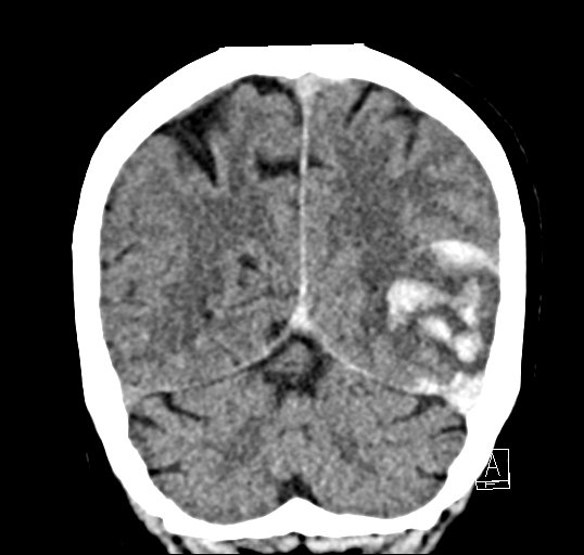 Cerebral venous infarction with hemorrhage (Radiopaedia 65343-74381 Coronal non-contrast 43).jpg