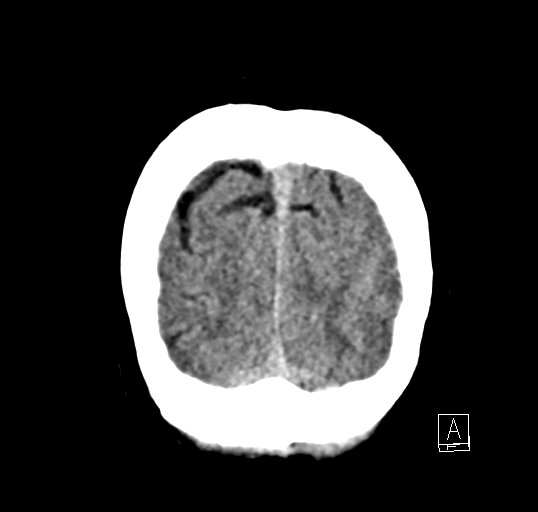 Cerebral venous infarction with hemorrhage (Radiopaedia 65343-74381 Coronal non-contrast 52).jpg
