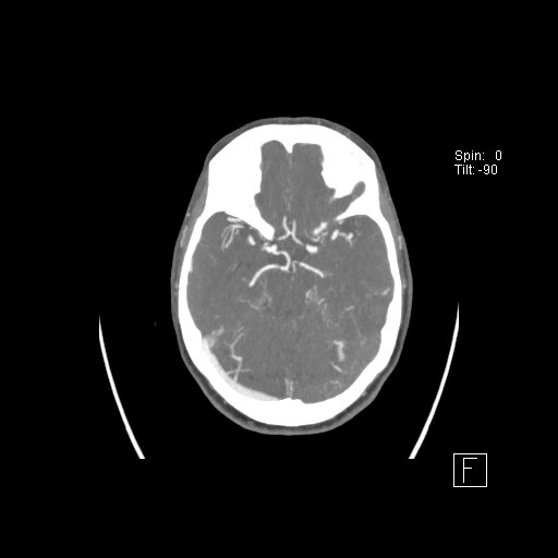 Cerebral venous infarction with hemorrhage (Radiopaedia 65343-74396 A 43).jpg