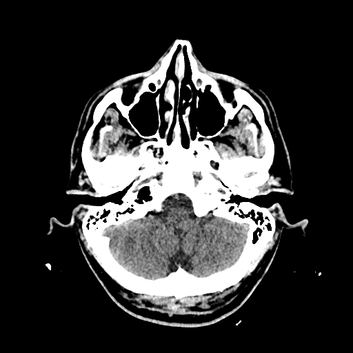 File:Cerebral venous thrombosis (CVT) (Radiopaedia 77524-89685 Axial non-contrast 8).jpg