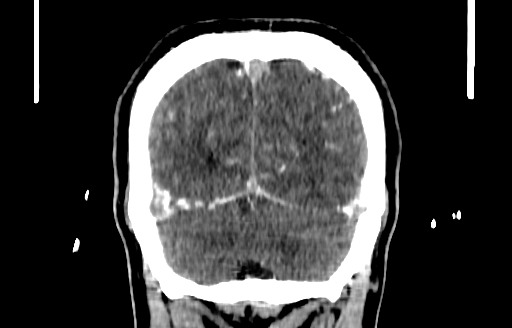 Cerebral venous thrombosis (CVT) (Radiopaedia 77524-89685 C 54).jpg