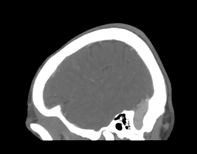 File:Cerebral venous thrombosis (Radiopaedia 38392-40467 D 9).png