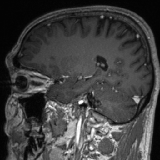 Cerebral venous thrombosis (Radiopaedia 38392-40469 Sagittal T1 C+ 58).png